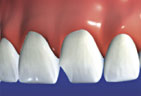 Chipped tooth that needs a crown Broken Tooth