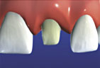 Preparing the tooth by eliminating the surface structure Crown preparation Step One