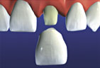 After Fabrication the crown is cemented to the prepared tooth Crown
