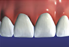 The Crown restoring natural beauty to the teeth Final Crown Step