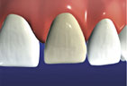 Veneers are prescribed for damaged, discolored, or broken teeth Veneer