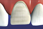 Preparing the tooth by eliminating the surface structure Veneer preparation step 1