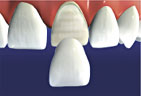 After Fabrication the veneer is cemented to the prepared tooth Veneer preparation step 2