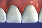Veneers restore natural beauty and health of teeth Final veneer step